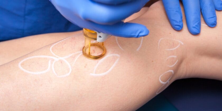 Tratament laser pentru venele capilare sparte in Bucuresti/Ilfov